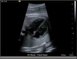 A fetal cardiology scan captured using an ACUSON S2000™ diagnostic ultrasound system from Siemens Healthcare.