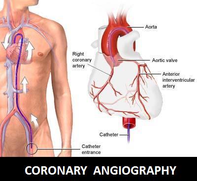 healthbase coronary angiography