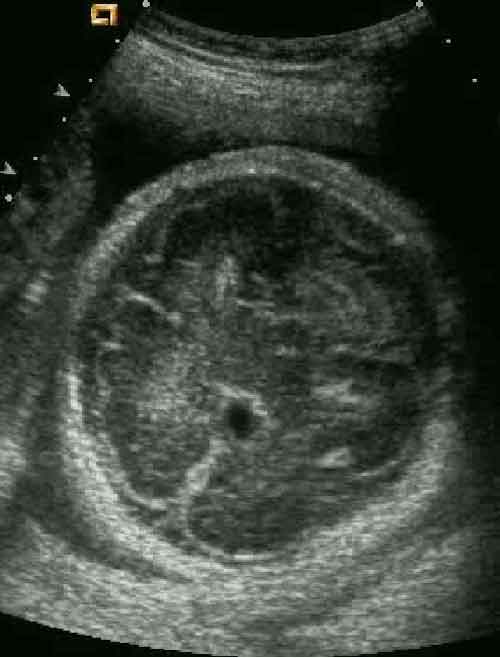 Free Obstetric Ultrasound Teaching Files & Radiology Cases | Obstetric